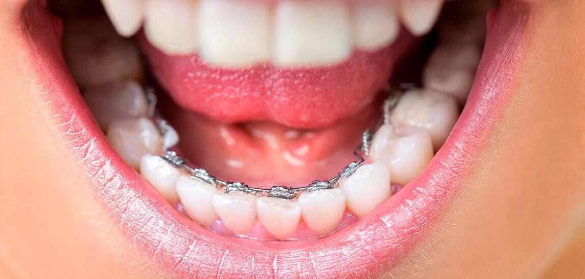 braquets