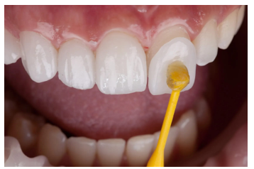 carillas-dental-sosua