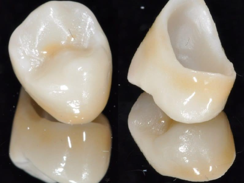 coronas-zirconio-dental-sosua