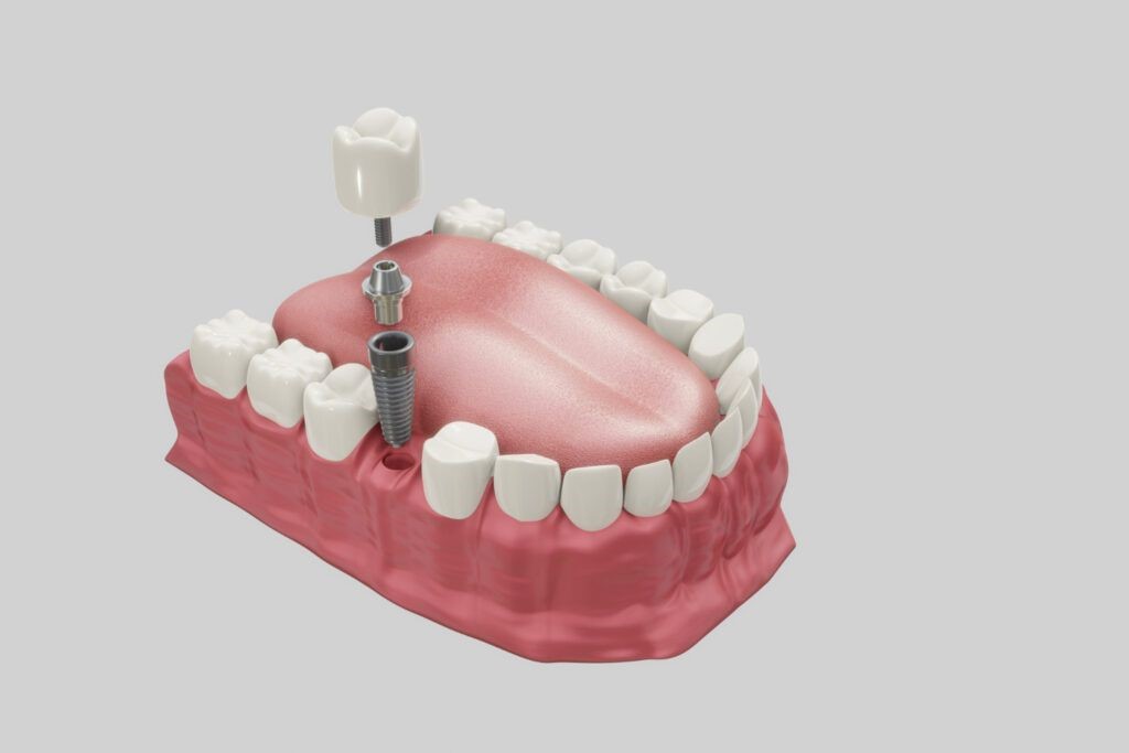 implantes2
