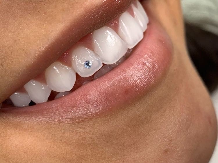 joyas-dentales